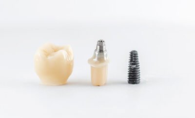 Dental Implants 05 400x242 1