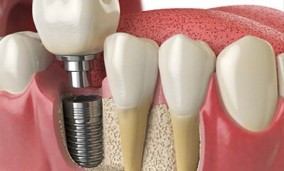 Dental Implants 06 400x242 1
