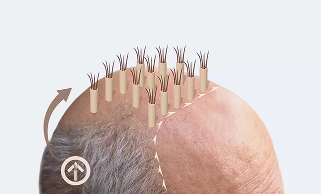 Fue Hair Transplant 01 jpg