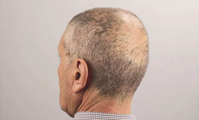 Fue Hair Transplant 02 jpg