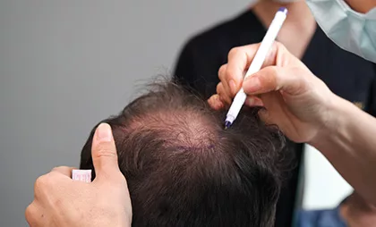 Fue Hair Transplant 06 jpg