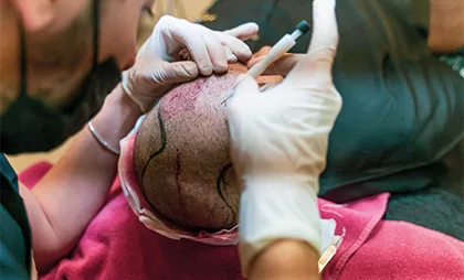 Fue Hair Transplant 07 jpg