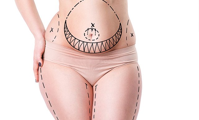 Tummy Tuck 01 1