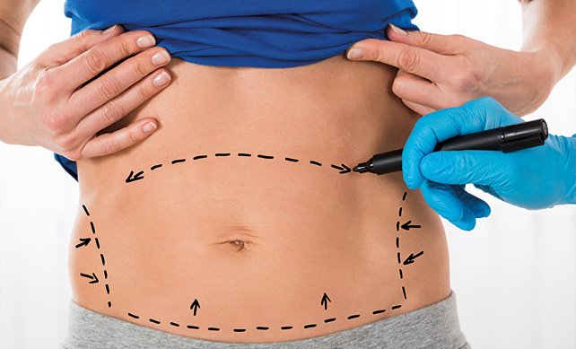 Tummy Tuck 03 1