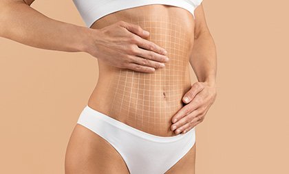 Tummy Tuck 06 1