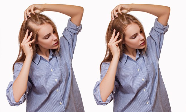 Women Hair Transplant 01