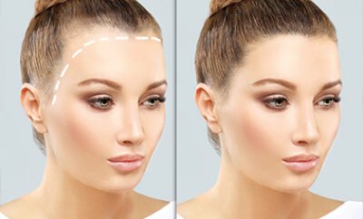 Women Hair Transplant 05 400x242 1