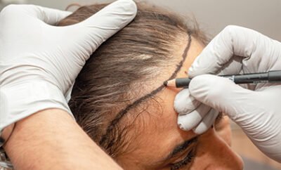 Women Hair Transplant 06 400x242 1
