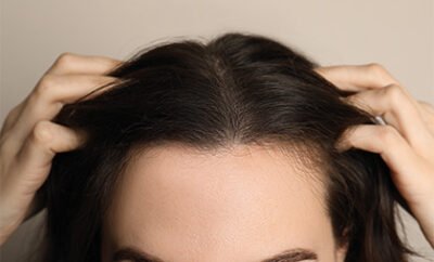Women Hair Transplant 07 400x242 1