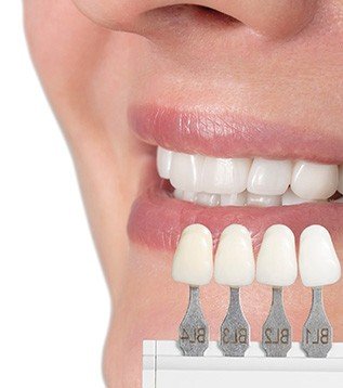 Teeth veneers 4